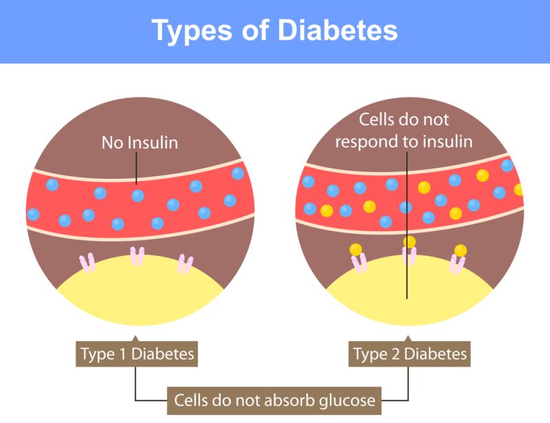 Tratament diabet tip 2